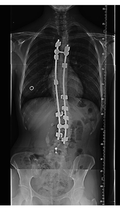 Hannah Taylor Spine Xray 2015 (surgery completed in February 1997).